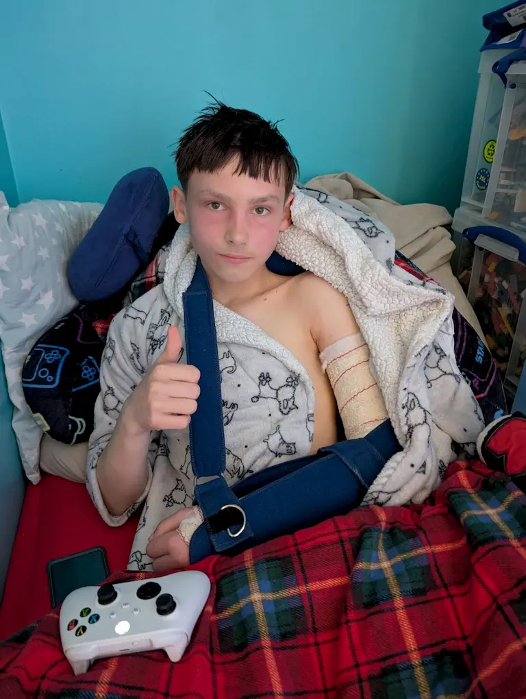 Cast after the arm break